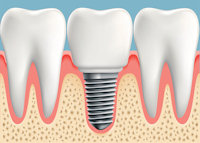 Dental Implants from Liberty Family Dentistry